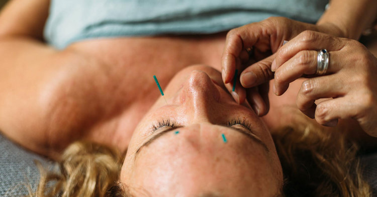 natural botox using Acupuncture