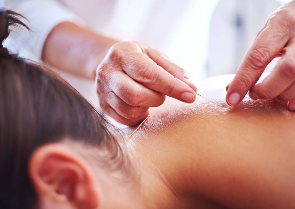 Pain Management with Acupuncture